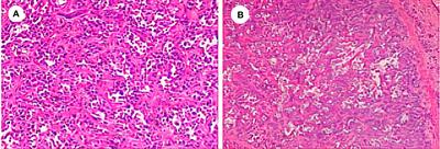 Treatment with palbociclib and tislelizumab for CDKN2A-mutated and PD-L1-positive advanced intrahepatic cholangiocarcinoma: a case report and literature review